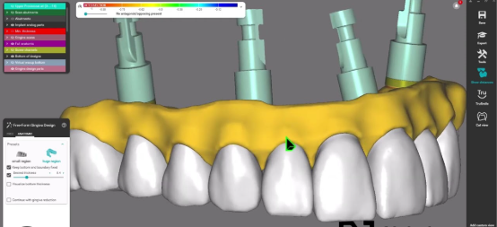 PMM  / FINAL ZIRCONIA DESIGN
